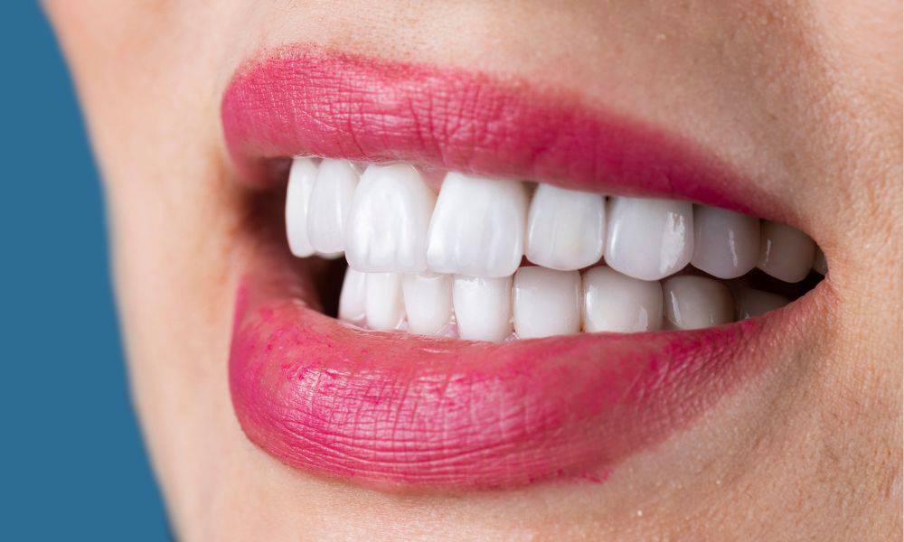 veneers in stoke