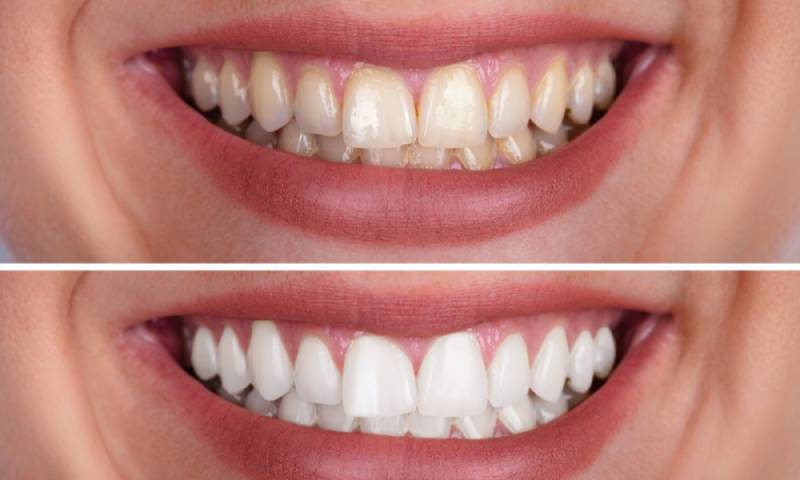 teeth whitening in stoke